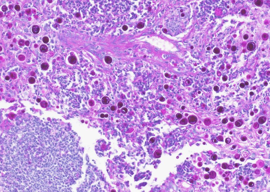A histological slide of valley fever spores in the lung tissue of a dog. 