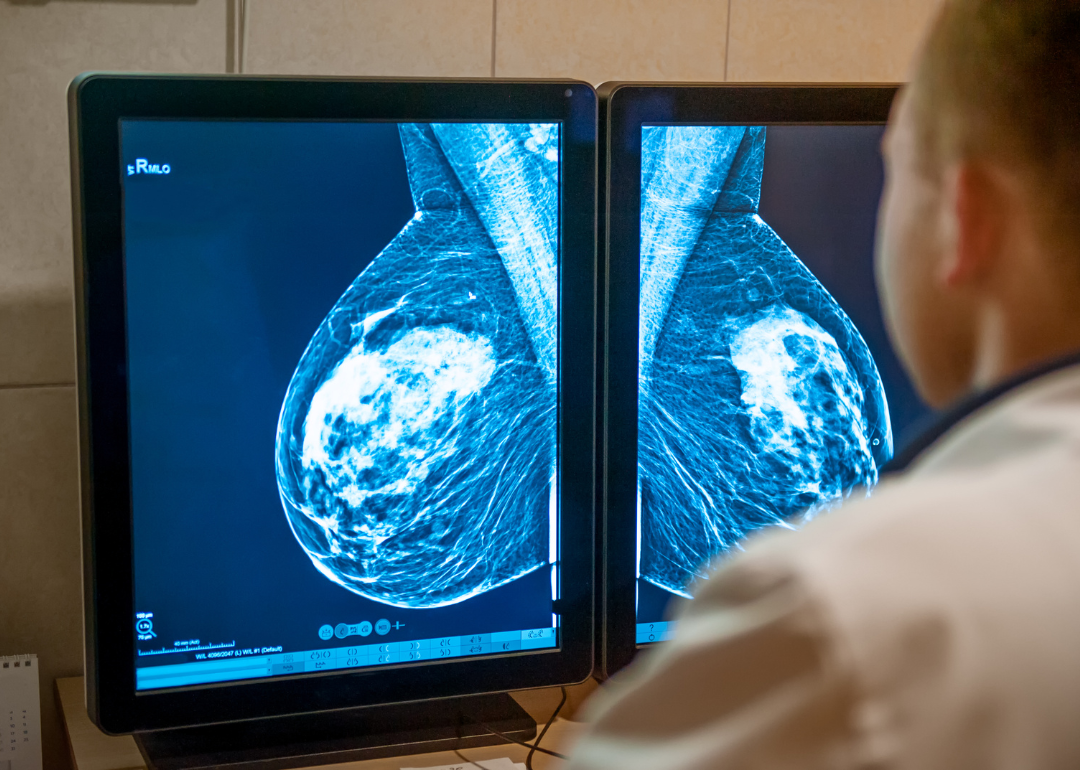 A person looking at a cancer scan.